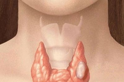 Những người nào có nguy cơ mắc ung thư tuyến giáp?