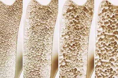 Mối liên hệ giữa mật độ xương thấp và nguy cơ suy giảm nhận thức