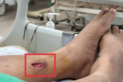 Vết thương do thanh tre đâm vào chân đã liền, người phụ nữ bất ngờ nguy kịch vì nguyên nhân này