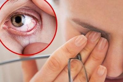 Chăm sóc người bị xuất huyết dưới kết mạc tại nhà