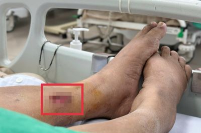 Vết thương đã lành, thứ còn sót lại khiến người phụ nữ nguy kịch