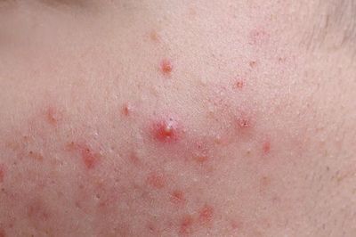 5 cách chăm sóc da và hạn chế trứng cá đỏ tái phát