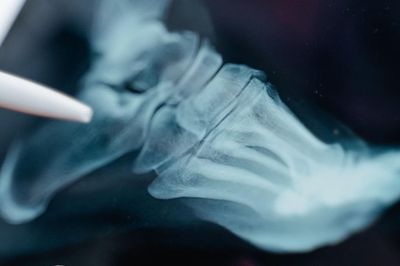 Nam giới uống vitamin C hằng ngày có giúp phòng ngừa bệnh gout?