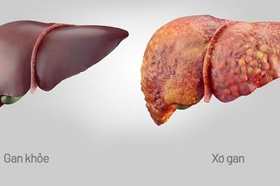 Lá gan sẽ 'mệt' thế nào nếu lạm dụng thực phẩm chức năng?