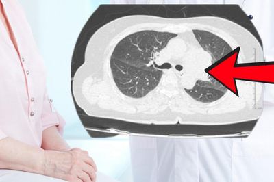 Không có triệu chứng hô hấp, người phụ nữ 40 tuổi vẫn phát hiện ung thư phổi