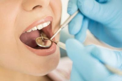 Lấy cao răng có được hưởng bảo hiểm y tế?