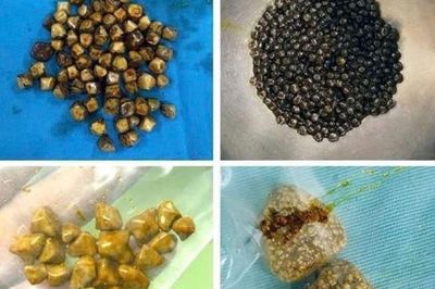 Bác sĩ bất ngờ khi gắp 49 viên sỏi trong túi mật người phụ nữ