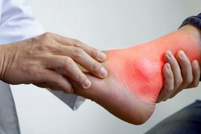 Bệnh gout không chỉ do ăn uống