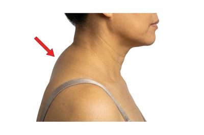 2 bài tập đơn giản tại nhà giúp cải thiện tư thế gù cổ