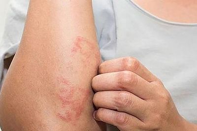 Mày đay mạn tính: Nhận diện đúng để điều trị hiệu quả