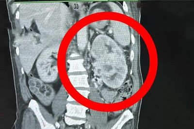 Có dấu hiệu này nhưng không đi khám, người đàn ông 64 tuổi mắc ung thư giai đoạn 4