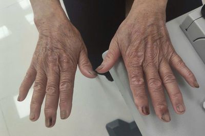 Móng tay dài, cặn bẩn đầy kẽ khiến người phụ nữ loét giác mạc