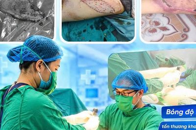 Ghép da cho bệnh nhân bỏng bô xe máy