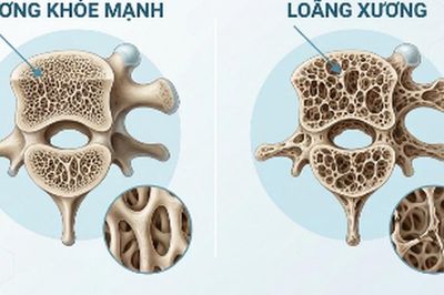 Nguy cơ gây loãng xương: Trường hợp nào cần chủ động đánh giá sức khỏe xương?