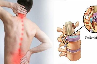 Bé 11 tuổi phát hiện mắc thoát vị đĩa đệm từ dấu hiệu nhiều người Việt mắc phải