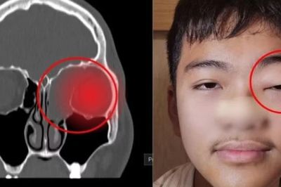 Không triệu chứng mũi xoang, bé trai phát hiện khối u 5 cm đẩy lồi nhãn cầu
