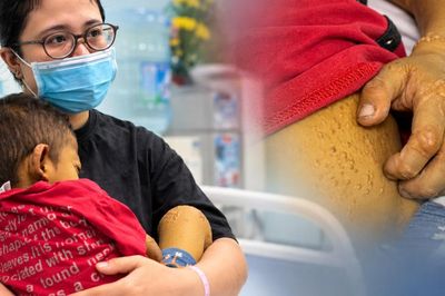 Xót xa bé 4 tuổi da vàng như nghệ suốt 4 năm, phải thay gan