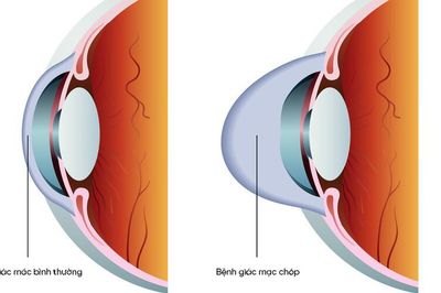 Giác mạc chóp - bệnh lý giác mạc cần được phát hiện và điều trị sớm
