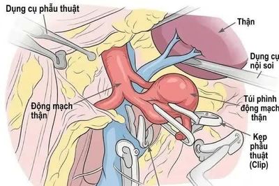 Thực hiện thành công phẫu thuật nội soi kẹp túi phình động mạch thận