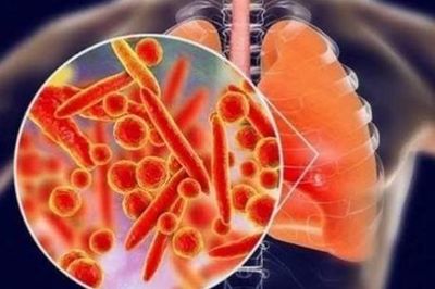 Nhân viên y tế ở Nga tử vong do viêm phổi: Có đáng lo ngại?