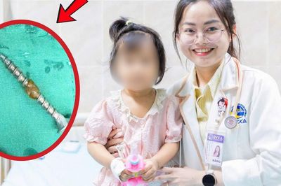 Bé gái 30 tháng tuổi suýt thủng đường tiêu hóa vì nuốt đinh vít 3cm khi chơi