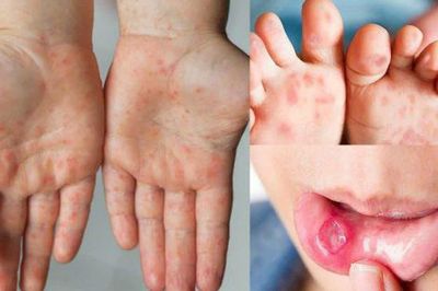 TPHCM: Tay chân miệng tăng gần 48%, sốt xuất huyết vẫn ở mức cao