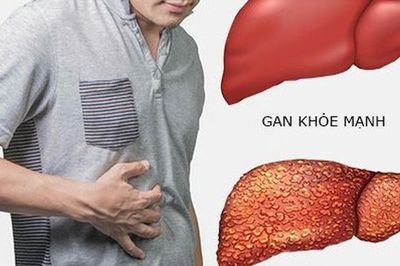 Bí quyết giúp giảm nguy cơ ung thư gan