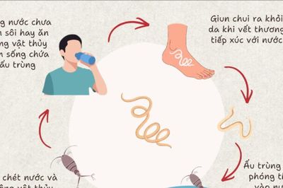 Thanh Hóa ghi nhận thêm một ca mắc bệnh giun rồng