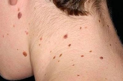 Chủ động nhận diện, phòng ngừa ung thư da