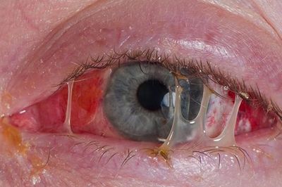 Sáng ngủ dậy hai mắt dính như keo, cụ bà phát hiện túi lệ đầy mủ