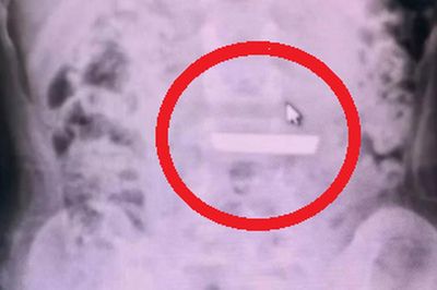 Bất ngờ phát hiện thỏi vàng trong bụng bé gái 5 tuổi