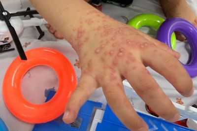 TPHCM: Ca tay chân miệng tăng mạnh, nhiều trẻ đồng nhiễm virus hô hấp