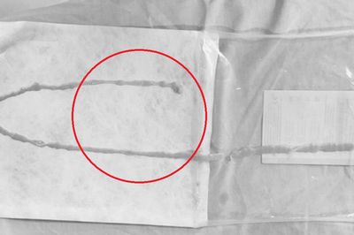 Người phụ nữ 48 tuổi sốc khi bác sĩ gắp ra thứ 'đáng sợ' bên trong bụng