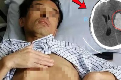 Người đàn ông đang khỏe mạnh bất ngờ đột quỵ, dấu hiệu nhiều người Việt bỏ qua