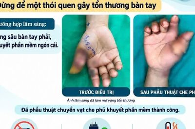 Bệnh nhân bỏng sâu bàn tay do điện thoại nổ khi sạc