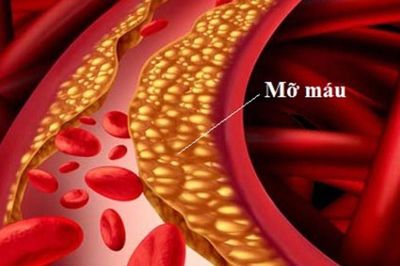 Triglyceride cao gây viêm tụy cấp nguy hiểm đe doạ tính mạng