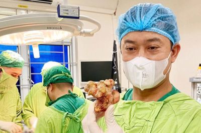 Phẫu thuật lấy khối sỏi san hô 'khủng' sau 20 năm âm thầm hình thành