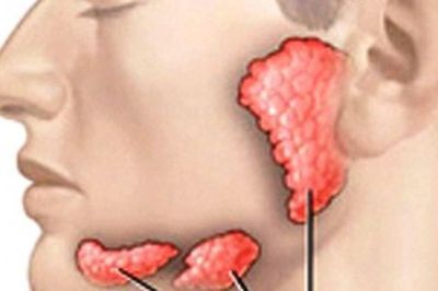 Sưng đau dưới lưỡi, cảnh giác với sỏi tuyến nước bọt