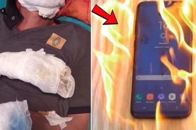 Bỏng nặng suýt mất tay vì dùng điện thoại khi đang sạc