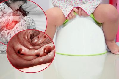 Bé gái đi ngoài ra máu kéo dài, nguyên nhân phía sau khiến gia đình bất ngờ