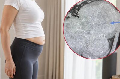 Bụng to bất thường, người phụ nữ 40 tuổi phát hiện 25 khối u xơ tử cung