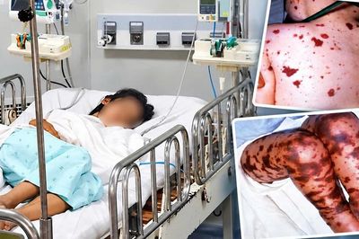 Bệnh não mô cầu có thể gây tử vong trong vài giờ