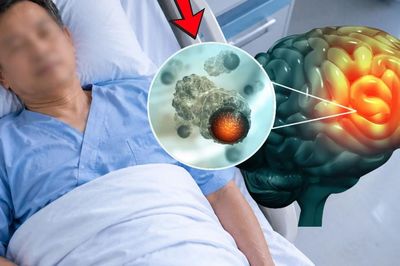 Ung thư não, tiên lượng sống 6 tháng, bệnh nhân sống thêm 10 năm nhờ 3 việc