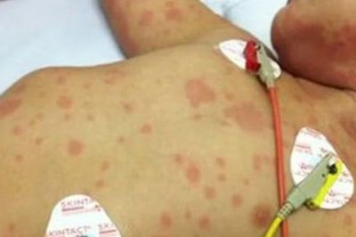 Bệnh não mô cầu, đừng chờ nổi ban mới đi viện
