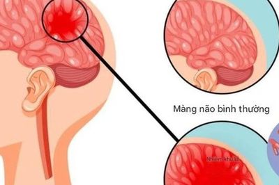 Khuyến cáo người dân chủ động phòng ngừa bệnh nhiễm trùng do não mô cầu