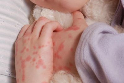 Cảnh báo căn bệnh đe dọa tính mạng chỉ trong vài giờ