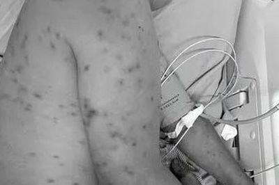 Bị hơn 300 con ong đốt, người đàn ông 62 tuổi nguy kịch