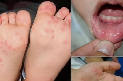 An Giang: Tập trung phòng, chống dịch bệnh sốt xuất huyết, tay chân miệng