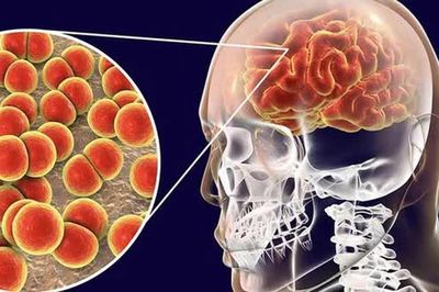 Triệu chứng, cách phòng bệnh não mô cầu