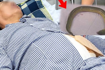 Người đàn ông 55 tuổi đau bụng dữ dội, bác sĩ gắp lươn sống dài 65 cm